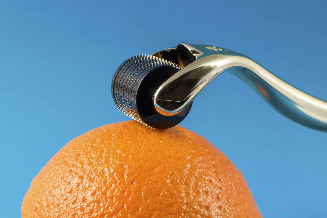 Does Microneedling for Hair Loss Work?