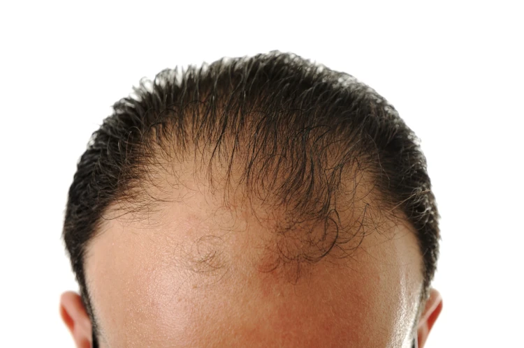 A close-up of a man's thinning hairline.