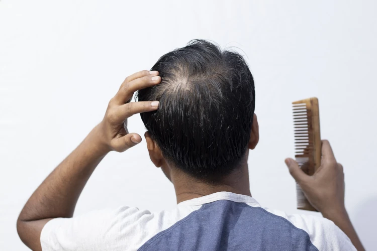 A man touching the thinning hair on his scalp.