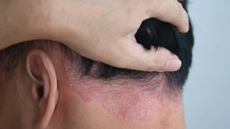 Scalp Psoriasis and Hair Loss: What Is the Connection?