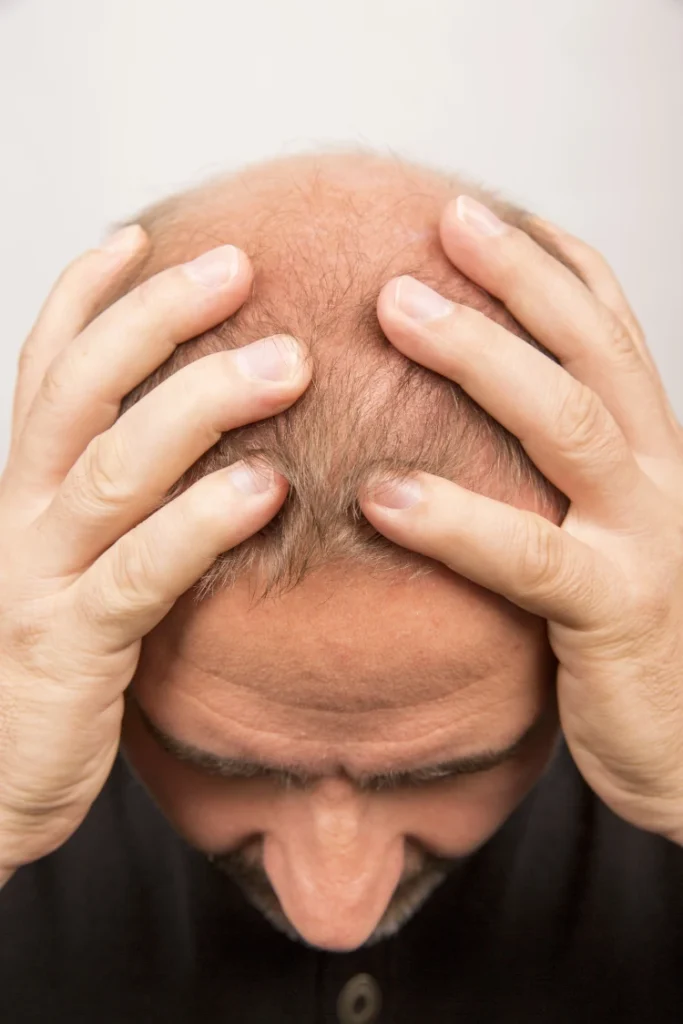 Stressed man with hair loss holding head in hands. 