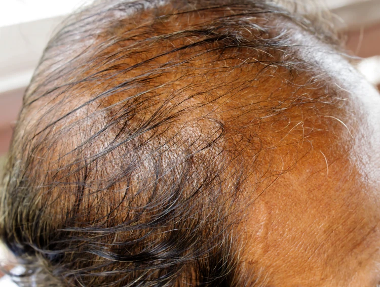 Liver Dysfunction and Hair Thinning: What You Need To Know