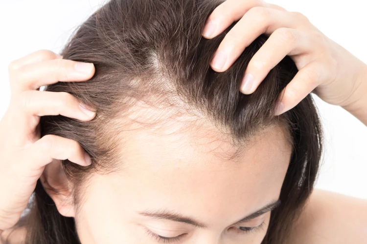 Link Between Diabetes and Hair Thinning