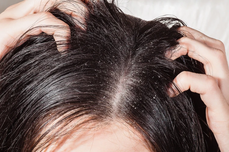 A close-up of a woman’s scalp with dandruff. 
