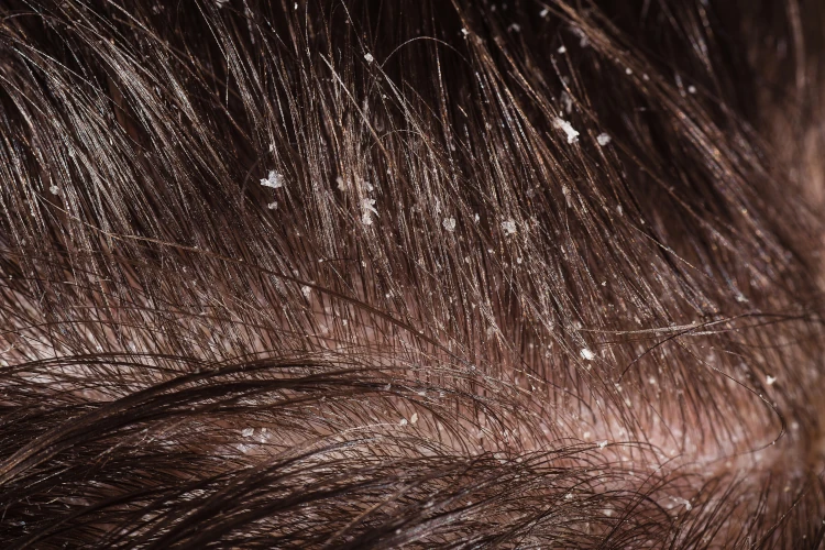 Does Dandruff Cause Hair Loss?